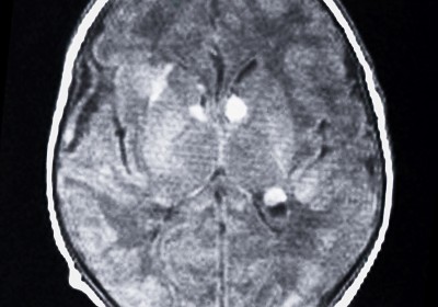 Información clínica de Esclerosis Tuberosa