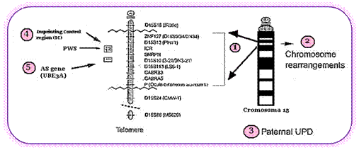 Síndrome de Angelman