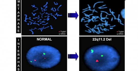 Síndrome Velocardiofacial